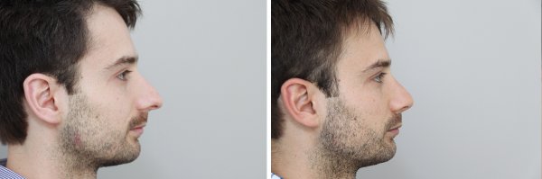 Male Rhinoplasty Before & After Photo 121