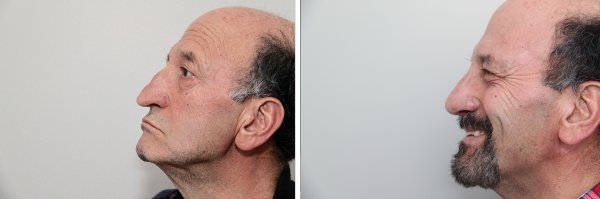 Male Rhinoplasty Before & After Photo 122