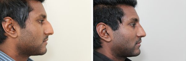 Male Rhinoplasty Before & After Photo 124