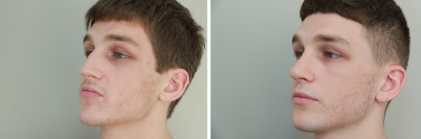 Male Rhinoplasty Before & After Photo 125