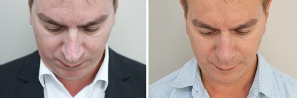 Male Rhinoplasty Before & After Photo 127