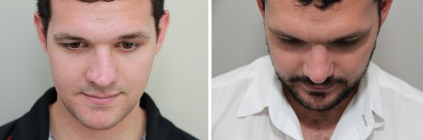 Male Rhinoplasty Before & After Photo 128