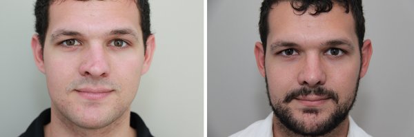 Male Rhinoplasty Before & After Photo 129