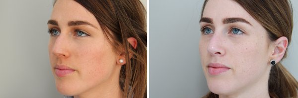 Rhinoplasty Before & After Photo 132