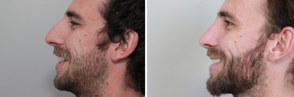 Male Rhinoplasty Before & After Photo 133