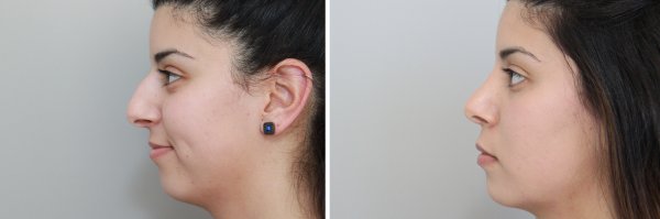 Rhinoplasty Before & After Photo 134