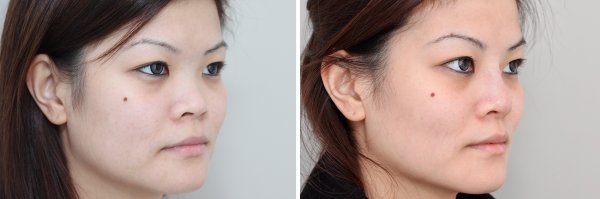 Non Surgical Rhinoplasty Before & Photo 135