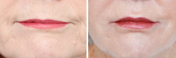 Facial Rejuvenation Before & After Photo 142