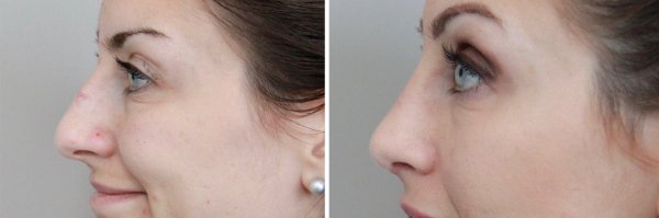 Rhinoplasty Before & After Photo 146