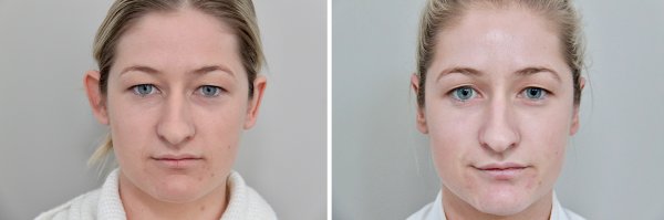 Otoplasty Before & After Photo 148