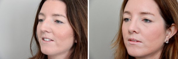 Rhinoplasty Before & After Photo 149