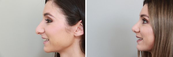 Rhinoplasty Before & After Photo 153