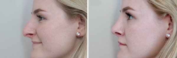 Rhinoplasty Before & After Photo 156