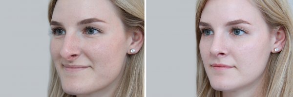 Rhinoplasty Before & After Photo 157