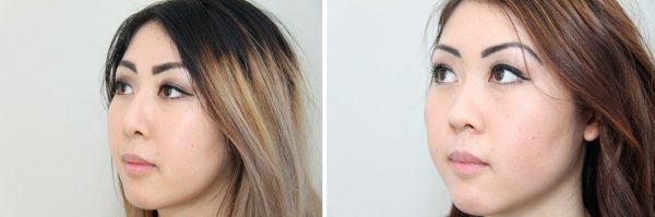 Asian Rhinoplasty Before & After Photo 34