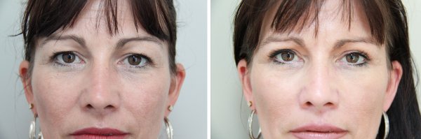 Blepharoplasty Before & After Photo 35