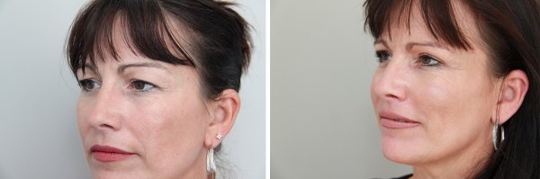 Blepharoplasty Before & After Photo 36