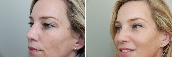 Blepharoplasty Before & After Photo 37