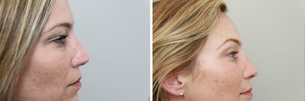 Blepharoplasty Before & After Photo 38