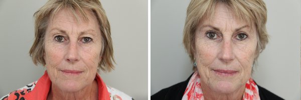 Blepharoplasty Before & After Photo 39