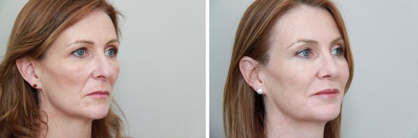 Facial Rejuvenation Before & After Photo 42
