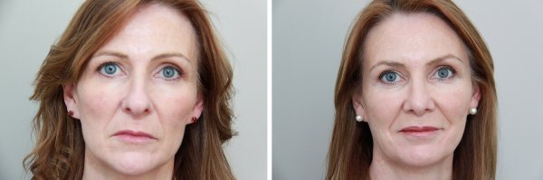 Facial Rejuvenation Before & After Photo 43