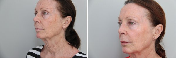 Facial Rejuvenation Before & After Photo 44