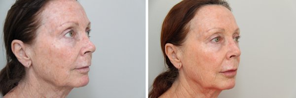 Facial Rejuvenation Before & After Photo 45