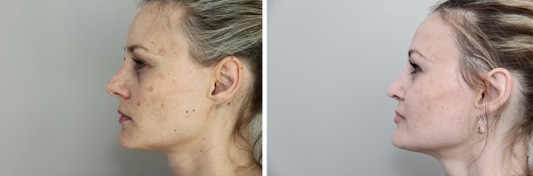Facial Rejuvenation Before & After Photo 46