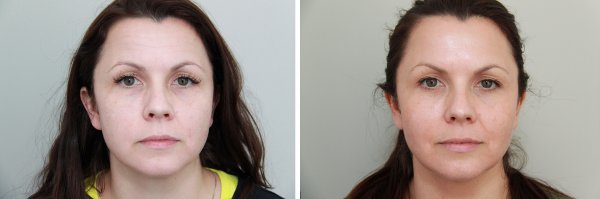 Facial Rejuvenation Before & After Photo 48