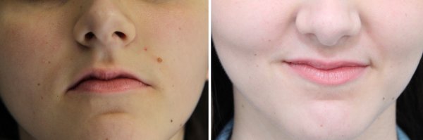 Mole Removal Before & After Photo 59