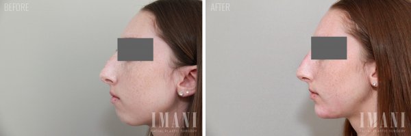 Non Surgical Rhinoplasty Before & Photo 60