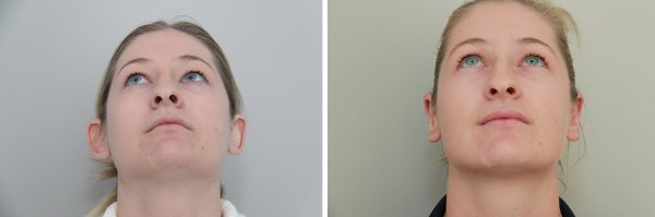 Otoplasty Before & After Photo 64