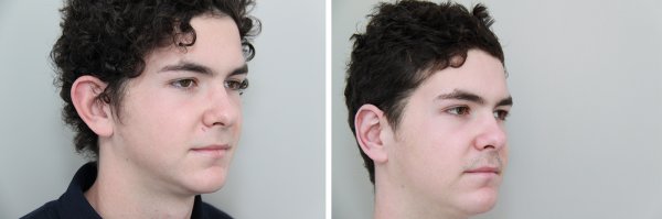 Otoplasty Before & After Photo 66