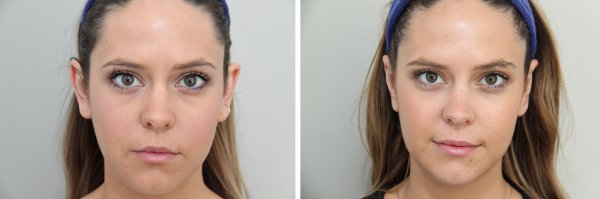 Otoplasty Before & After Photo 72