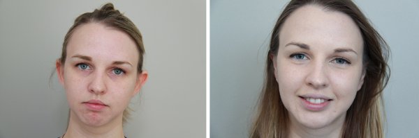 Otoplasty Before & After Photo 73