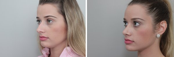 Rhinoplasty Before & After Photo 75