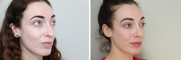 Rhinoplasty Before & After Photo 76