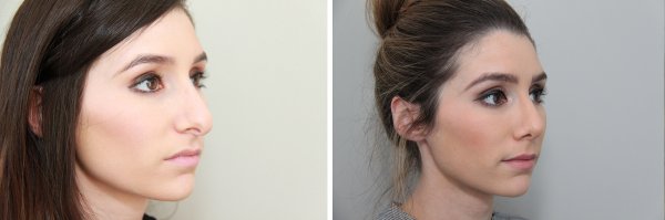 Rhinoplasty Before & After Photo 78
