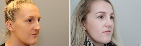 Rhinoplasty Before & After Photo 79