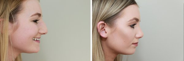 Rhinoplasty Before & After Photo 81