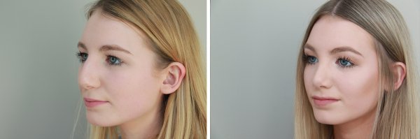 Rhinoplasty Before & After Photo 82
