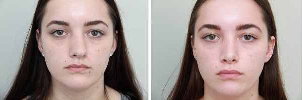Rhinoplasty Before & After Photo 83