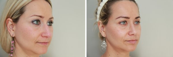 Rhinoplasty Before & After Photo 84