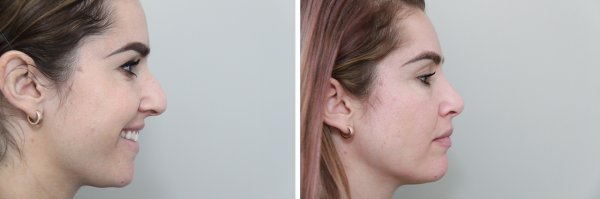 Rhinoplasty Before & After Photo 85