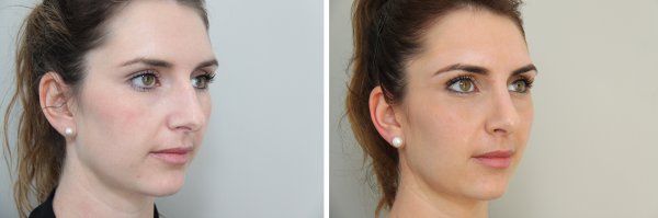 Rhinoplasty Before & After Photo 86