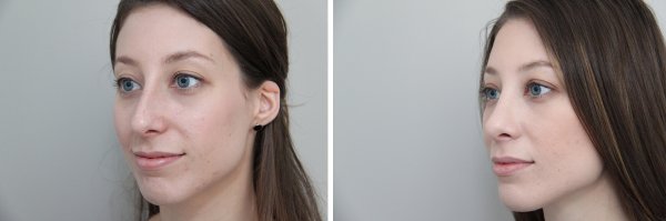Rhinoplasty Before & After Photo 89