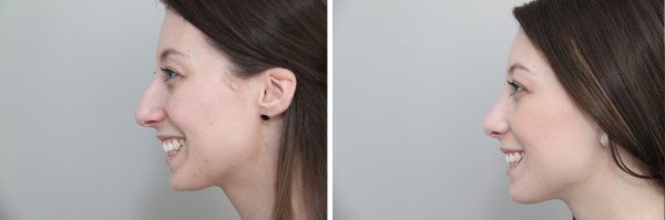 Rhinoplasty Before & After Photo 90