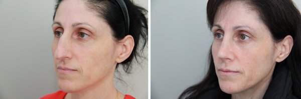 Rhinoplasty Before & After Photo 91
