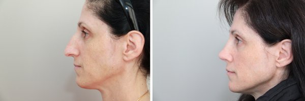 Rhinoplasty Before & After Photo 92